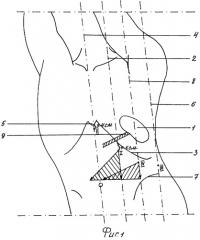 Способ операционного доступа при лапароскопической спленэктомии (патент 2310416)