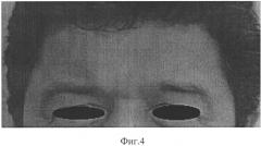 Способ омоложения кожи лица у пациентов с анатомо-физиологическими особенностями лицевой части черепа (патент 2571686)
