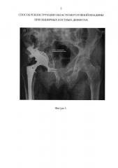 Способ реконструкции области вертлужной впадины при обширных костных дефектах (патент 2656522)