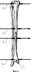 Способ лечения осевых деформаций диафиза костей голени (патент 2446760)