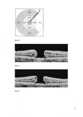 Способ прогнозирования анатомического результата лечения идиопатического макулярного разрыва (патент 2597571)
