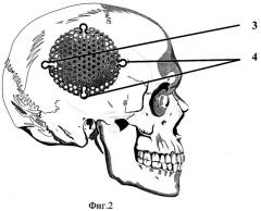 Устройство для закрытия дефектов костей свода черепа (патент 2308909)