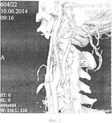 Способ хирургического лечения аневризматического поражения позвоночной артерии на шейном уровне (патент 2558457)