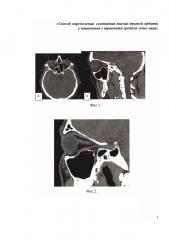 Способ определения состояния мягких тканей орбиты у пациентов с травмами средней зоны лица (патент 2661006)