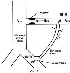 Способ определения показаний к формированию тестикуло-илиакального анастомоза при лечении венозной почечной гипертензии с варикоцеле (патент 2395233)