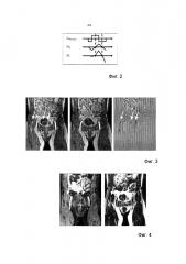 Магнитно-резонансная визуализация с подавлением артефактов потока (патент 2605524)