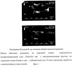 Способ лечения миомы матки (патент 2277950)