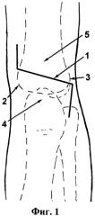 Способ заднего доступа к дистальному отделу плечевой кости у детей (патент 2457803)