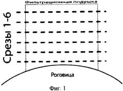 Способ исследования фильтрационной подушки после операции непроникающей глубокой склерэктомии (патент 2319474)