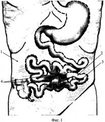 Способ формирования кишечной стомы (патент 2532304)