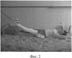 Способ восстановления подвижности в тазобедренном суставе (патент 2411024)