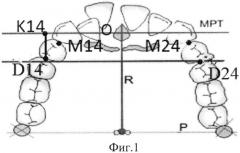 Способ выбора варианта ортодонтического лечения с удалением и без удаления отдельных зубов (патент 2547998)