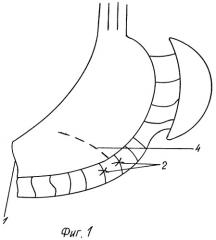 Способ формирования желудочно-панкреатического анастомоза (патент 2254074)