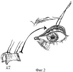 Способ устранения сквозного краевого дефекта верхнего века (патент 2380066)