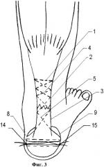 Способ хирургического лечения свежего подкожного разрыва ахиллова сухожилия (патент 2393804)