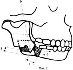 Способ увеличения длины тела и ветви нижней челюсти у детей (патент 2362499)