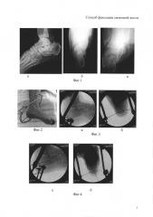 Способ фиксации пяточной кости (патент 2613727)