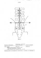 Фиксатор позвоночника (патент 1326261)