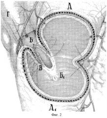Способ хирургического лечения осложненных низких дуоденальных язв (патент 2257166)