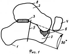 Способ лечения плоско-вальгусной деформации стопы у детей (патент 2311145)