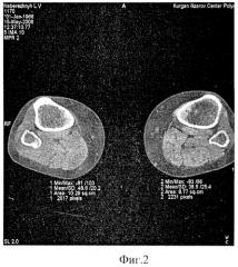 Способ оценки морфофункциональной перестройки мышц у больных с повреждениями и заболеваниями нижних конечностей (патент 2327418)