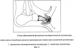 Способ формирования культи стопы (патент 2308244)