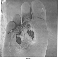 Способ лечения нейропатических трофических язв при синдроме диабетической стопы (патент 2549459)