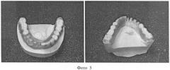 Способ снятия оттисков с использованием индивидуальной ложки при протезировании ортопедическими конструкциями (патент 2458654)