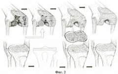 Способ замещения костных дефектов мыщелков большеберцовой или бедренной костей при тотальном эндопротезировании коленного сустава (патент 2465855)