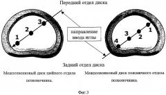 Способ и система для создания контролируемых неоднородностей структуры и механических напряжений в хрящевых тканях (варианты), а также способ введения лекарственных и других полезных веществ для контролируемой активации регенерационных процессов (варианты) (патент 2422114)