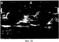 Способ ультразвуковой диагностики распространенности рака молочной железы в мягкие ткани передней грудной стенки (патент 2423919)