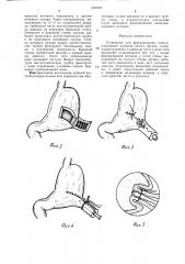 Устройство для формирования инвагинационного клапана (патент 1397027)