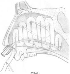 Устройство для введения лекарственных веществ в полость носа при тампонаде (патент 2405586)