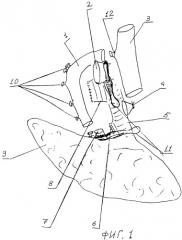 Способ правосторонней верхней билобэктомии при опухолях легкого (патент 2255670)