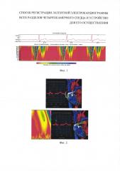 Способ регистрации латентной электрокардиограммы всех разделов четырехкамерного сердца и устройство для его осуществления (патент 2633347)
