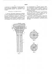 Система крепления эндопротеза диафиза к кости (патент 581937)