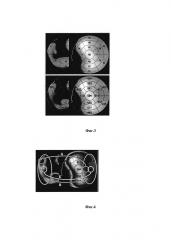 Способ количественной оценки нарушений перфузии миокарда правого желудочка по данным однофотонно-эмиссионной компьютерной томографии (патент 2628367)