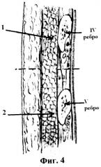 Способ боковой торакотомии (патент 2336031)