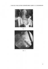 Способ выполнения трансартикулярной фиксации с1-с2 позвонков (патент 2662203)