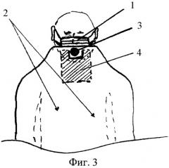 Стоматологическая салфетка (патент 2411924)