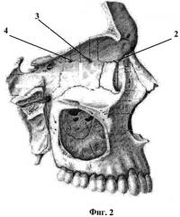 Окончательная остановка носового кровотечения при травме решетчатого лабиринта с использованием эндоскопической техники и инструмента (патент 2495629)