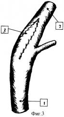 Способ пластики наружной сонной артерии (патент 2359620)