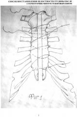Способ восстановления целостности грудины после стернотомии многостежковым швом (патент 2598969)