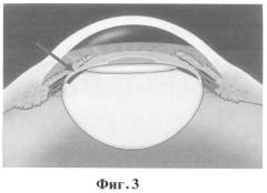Способ устранения капсульного блока при помощи иаг-лазера (патент 2276598)