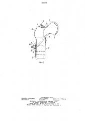 Устройство для остеосинтеза бедренной кости при межвертельной остеотомии (патент 1258398)