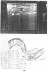 Способ ультразвукового исследования состояния диска височно-нижнечелюстного сустава (патент 2292842)