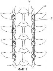 Устройство для спинального остеосинтеза и способ его подготовки (патент 2288667)