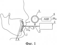 Стоматологический прибор "вестибулотонометр" для определения степени воздействия мышц, окружающих ротовую щель, на зубы и челюсти (патент 2355357)