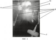 Устройство для выполнения фистулографии у больных с прямокишечными свищами (патент 2423075)