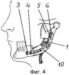 Способ костной пластики нижней челюсти (патент 2281704)
